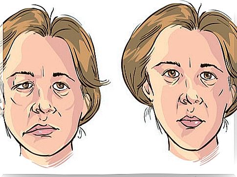 Facial paralysis in a woman